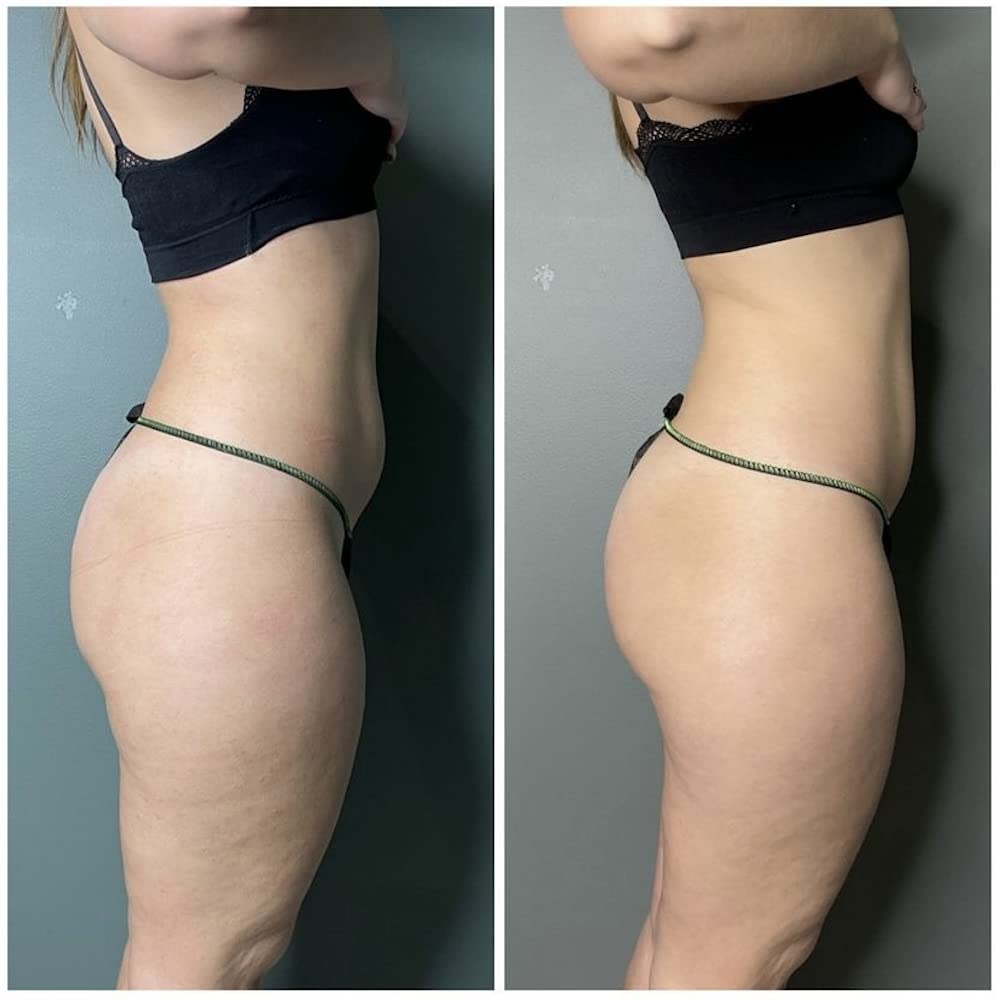 GUAM Cellulite Remover Kit, Cellulite Treatment Set, Bundle Pack 2-in-1: Hot Seaweed Mud Body Wrap with Tourmaline, FIR 1KG + Skin Tightening Cream Gel, FIR 250 ML