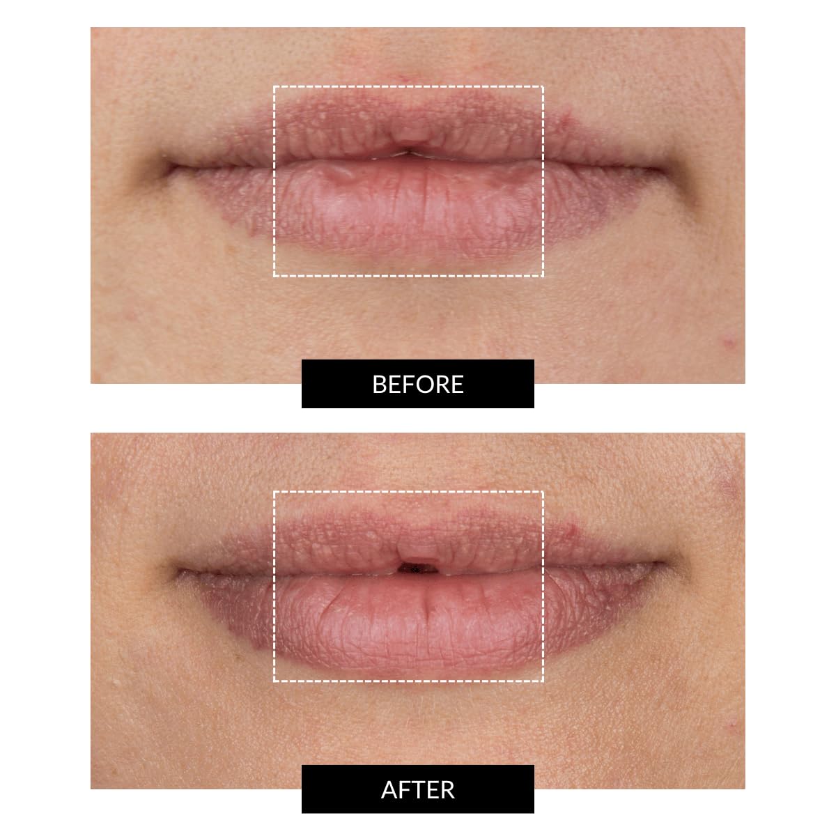 CurrentBody Skin LED Lip Perfector | Fully Wearable Anti-Aging Device for Lips | Soften Feather and Smile Lines for Plumper and Fuller Lips